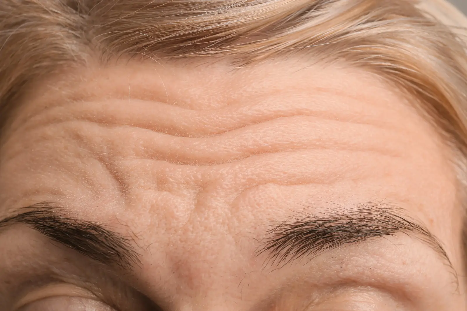 Botox reduces wrinkles