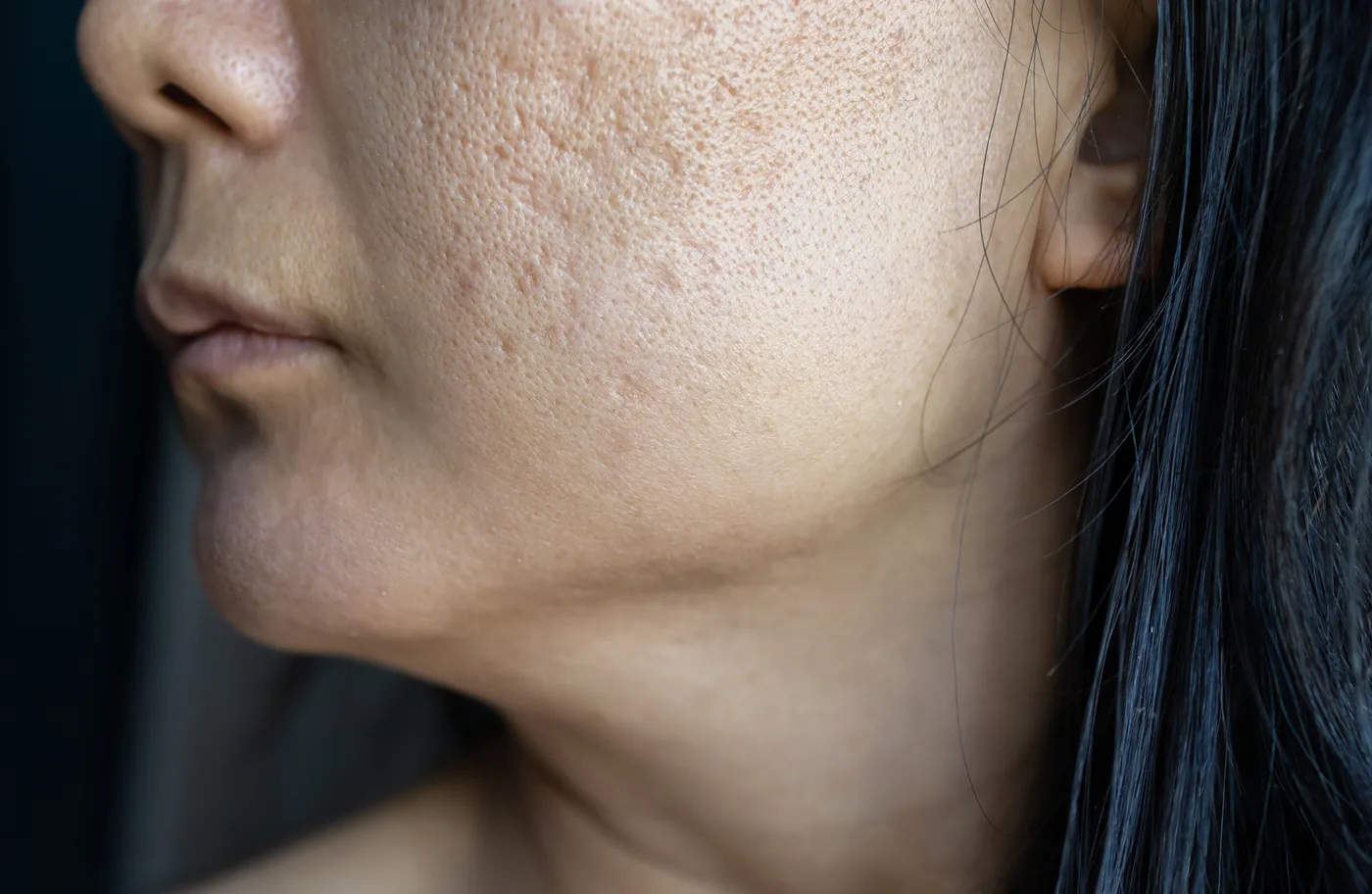 Vampire facial in Goregaon for acne scars and uneven skin texture