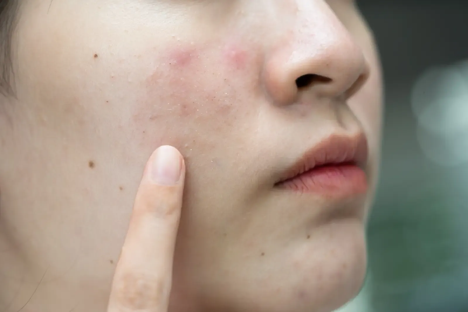 PRP facial in Mumbai for adults 25 to 40 with dull skin and early ageing