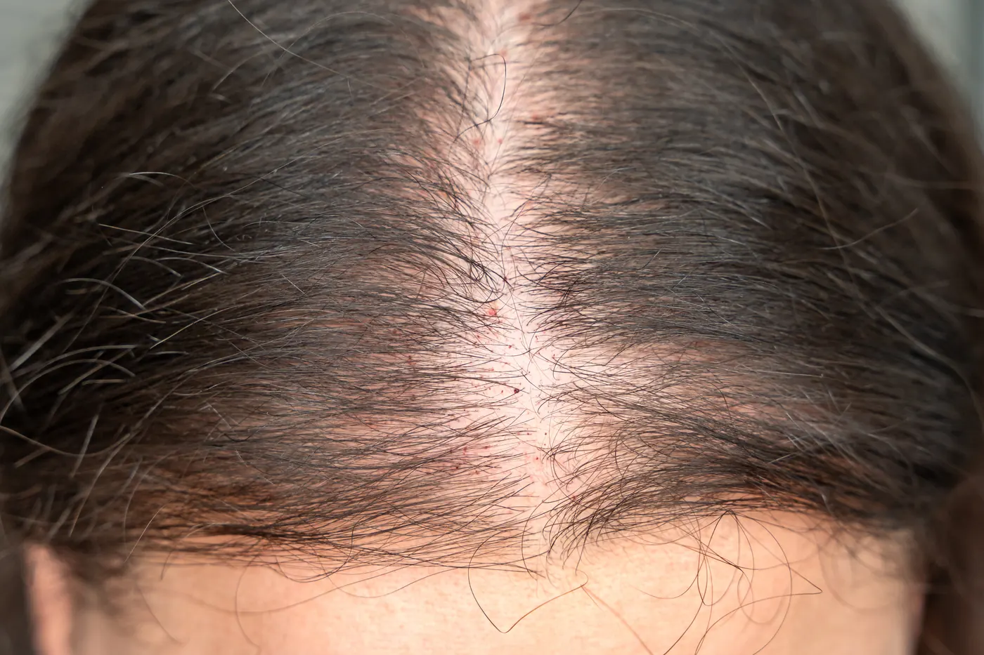 Man with pattern hair loss suitable for exosome therapy for hair in Mumbai