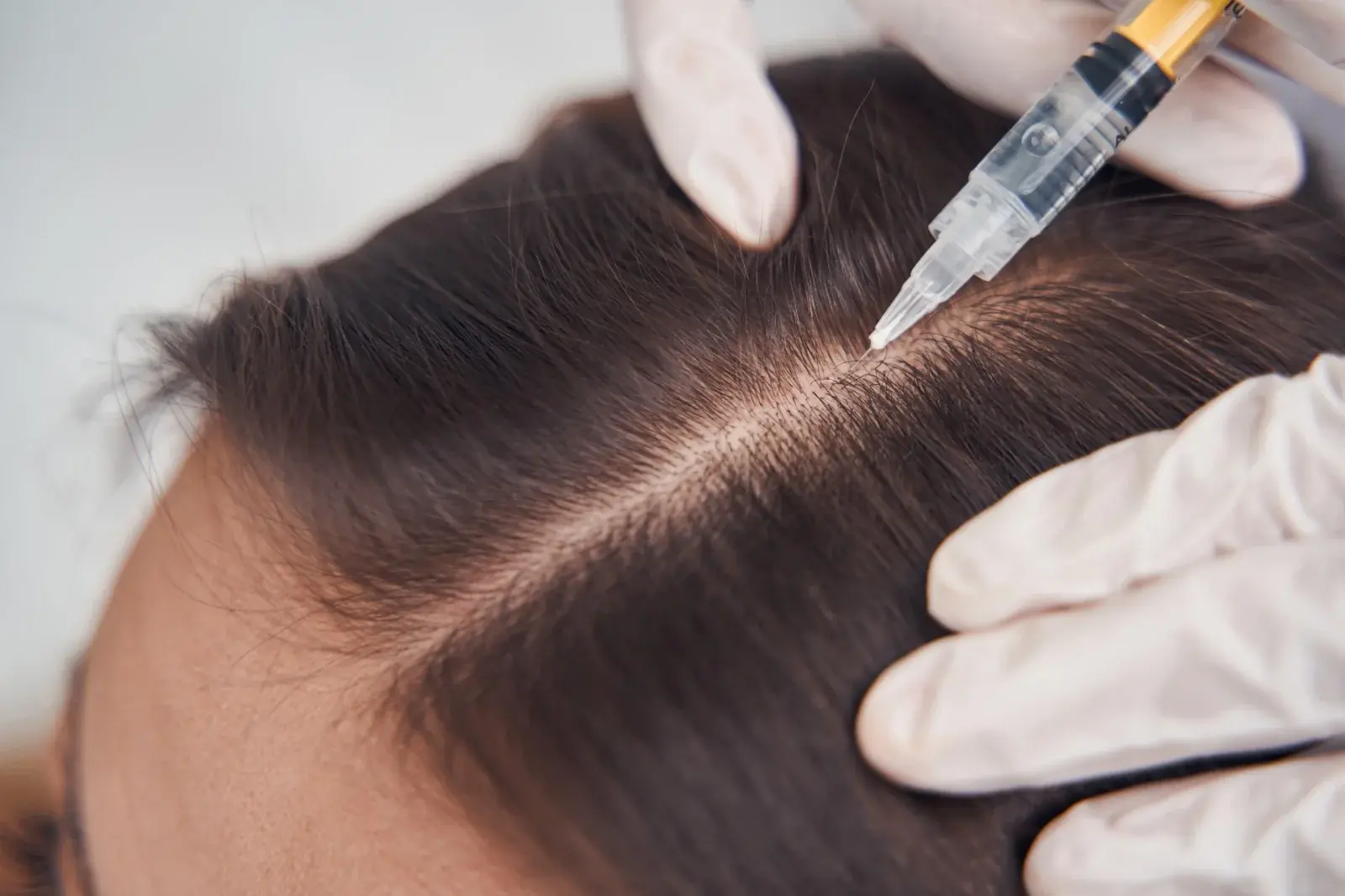 Hair restoration regenerative therapy at Aevum Health