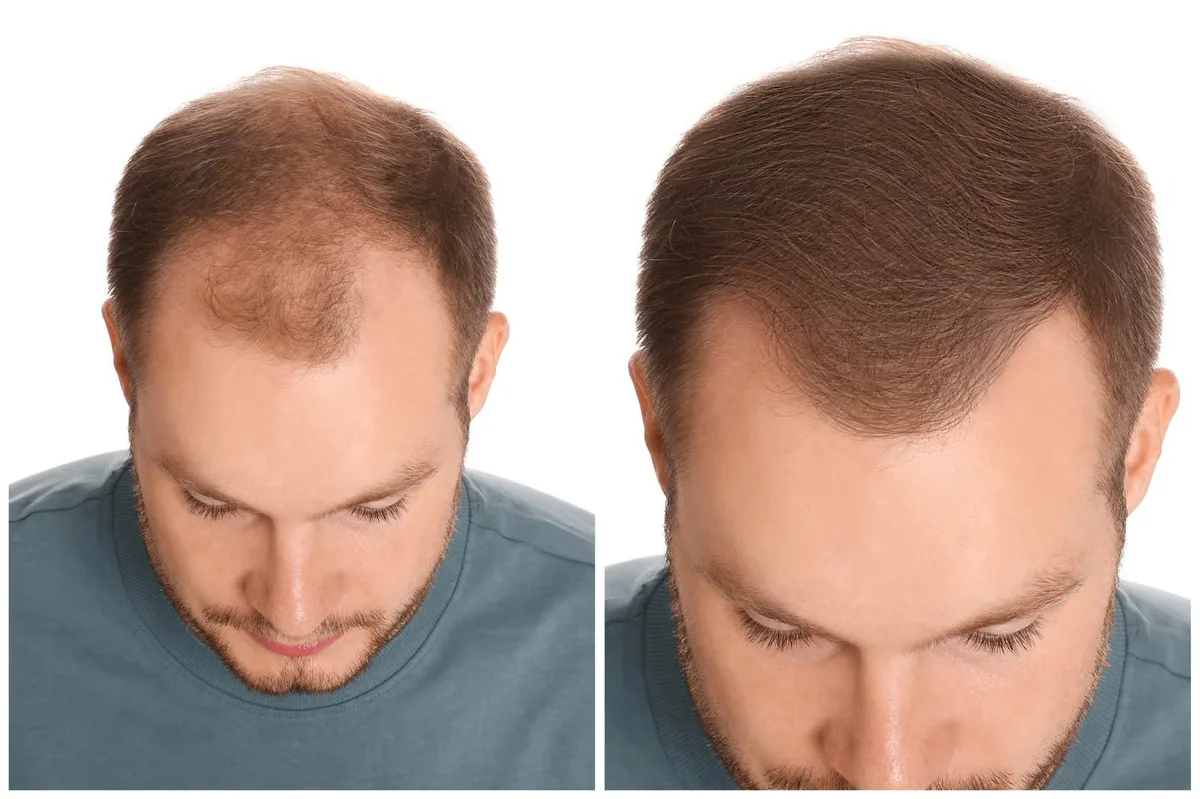 Advanced hair loss treatments at Aevum Health, Goregaon West Mumbai