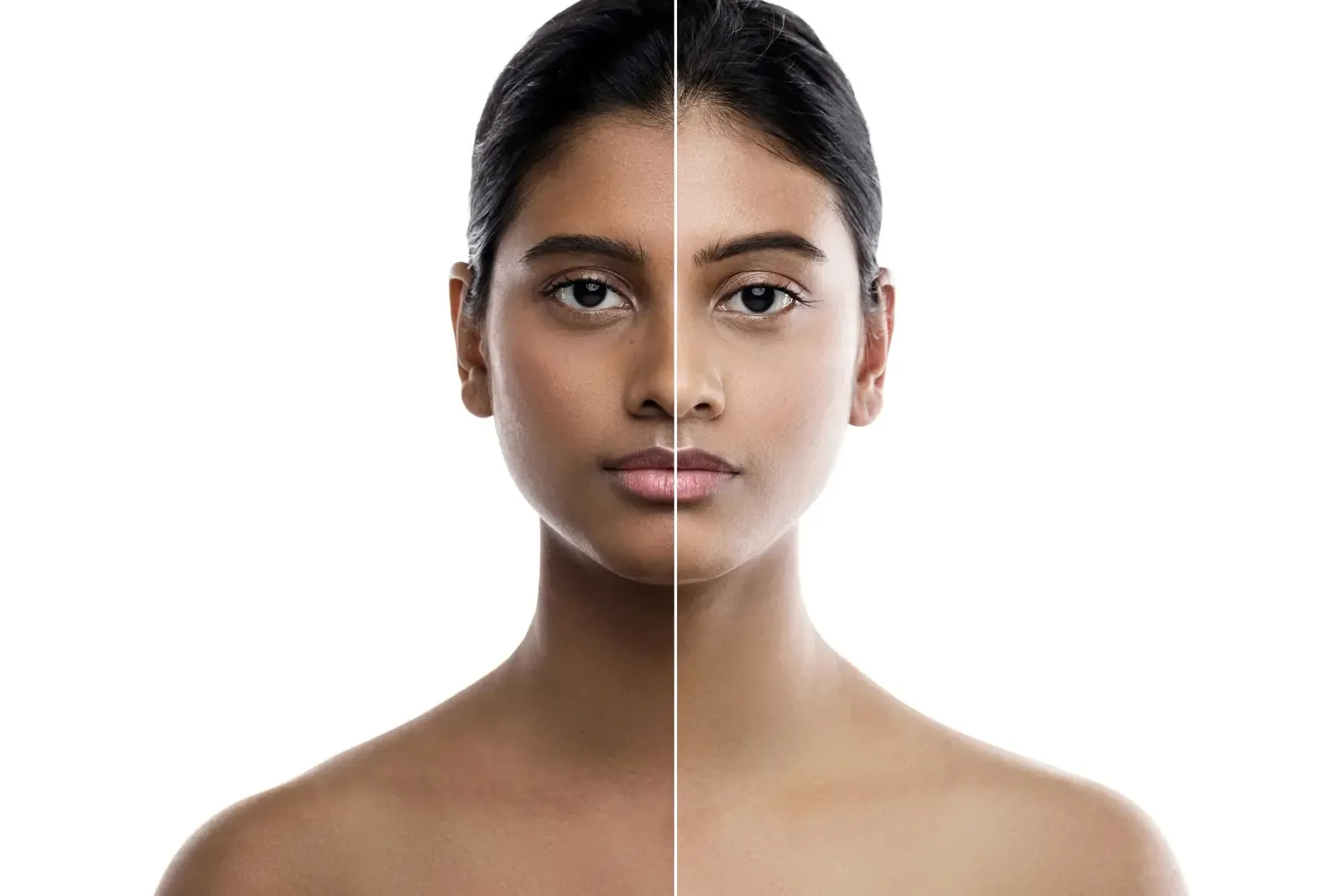 Reduced pigmentation and dullness after Face PRP