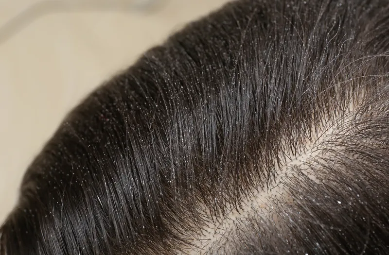 Dandruff