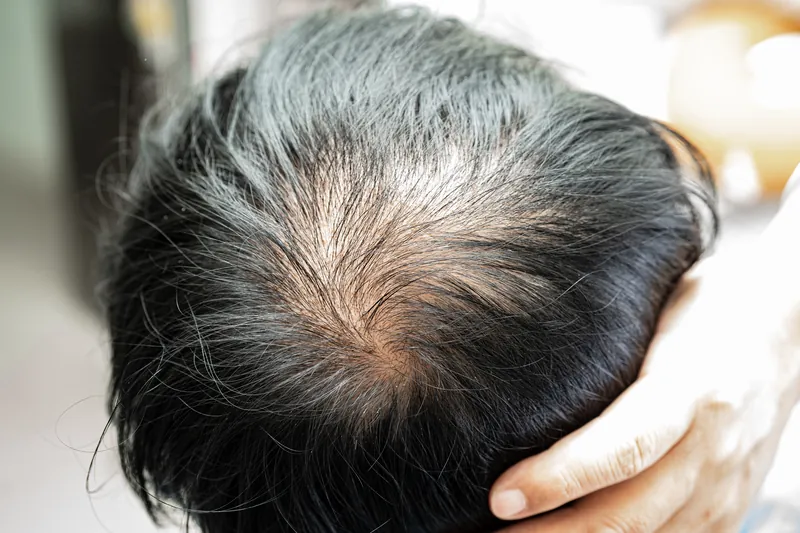 Hair Thinning