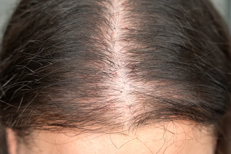 Telogen Effluvium