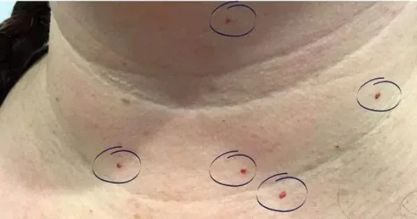 Pigmented Lesions