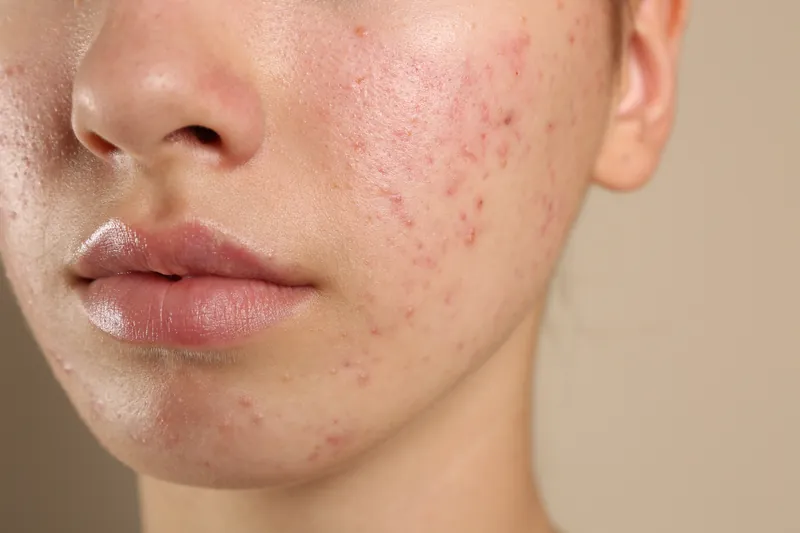 Acne