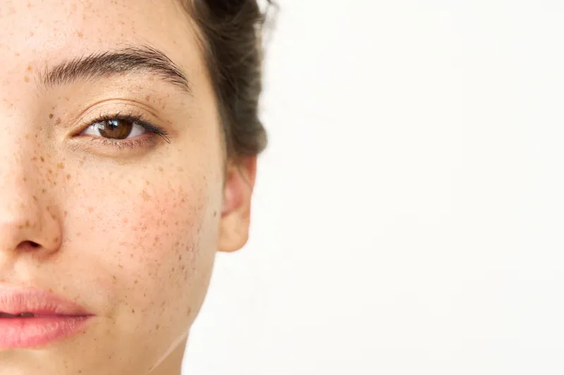 Pigmentation